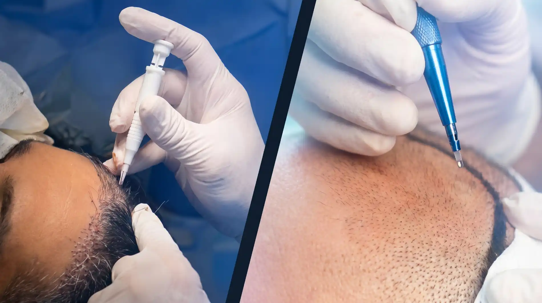 FUE vs DHI: Which Hair Transplant Technique Is Right for You?